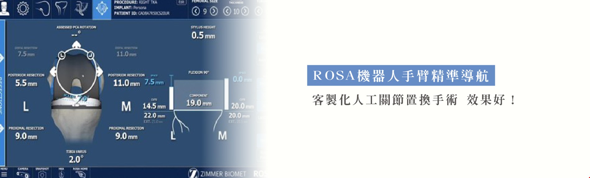 ROSA機器人手臂精準導航  客製化人工關節置換手術 效果好！