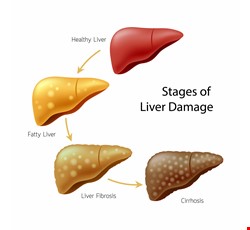 Liver Cirrohsis 肝硬化診斷與治療