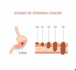 Early Symptoms of Stomach Cancer 胃癌的早期症狀