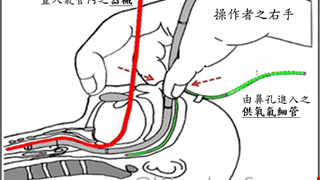 兒童氣管鏡檢查及治療