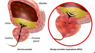 攝護腺肥大症