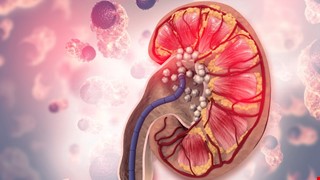 Kidney Stone Prevention 腎結石預防措施