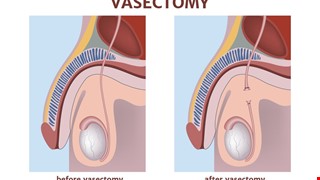 輸精管結紮注意事項
