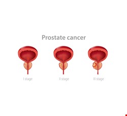 Prostate-Specific Antigen Interpretation 攝護腺特定抗原PSA判斷說