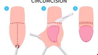 包皮環切手術後注意事項
