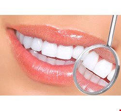Teeth Whitening 談牙齒美白