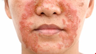 Seborrheic Dermatitis 脂漏性皮膚炎