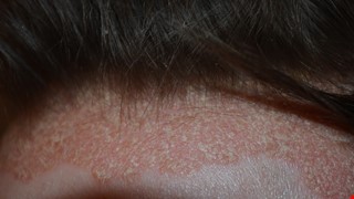 Psoriasis 乾癬