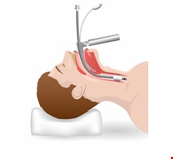 Laryngomicrosurgery (LMS) 喉部顯微手術介紹