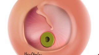 中耳通氣管置放術後衛教說明