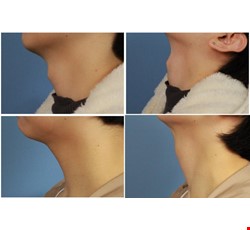 Scarless Thyroid Cartilage Reduction 無疤痕喉結減積手術
