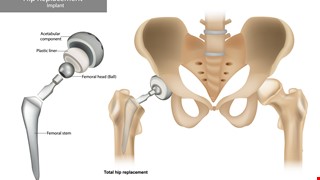 認識人工髖關節置換術