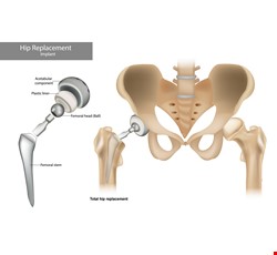 Getting to know Artificial Hip Joint Replacement Surgery 認識人工髖關節置換術
