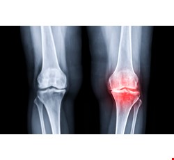 Osteoarthritis 認識退化性膝關節炎