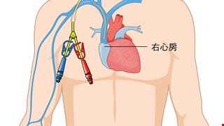 Dressing Change on a Hickman Catheter and Home Care 希克曼導管換藥與居家照護