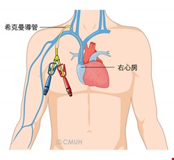 Dressing Change on a Hickman Catheter and Home Care 希克曼導管換藥與居家照護