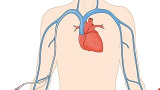 Peripherally Inserted Central Catheter (PICC) Dressing Change and Home Care 週邊置入中心靜脈導管(PICC)換藥與居家照護