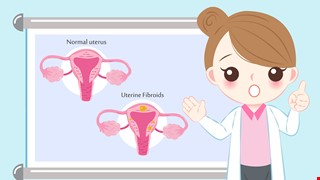 Information about Uterine Myoma 子宮肌瘤知多少？