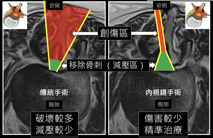 張建鈞醫師|電腦導航微創脊椎手術 電腦導航微創脊椎手術