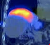 肝癌 釔90  體內放射療法 