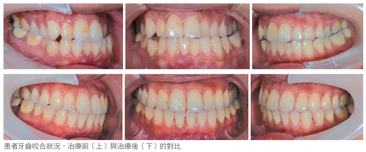 患者牙齒咬合狀況，治療前（上）與治療後（下）的對比