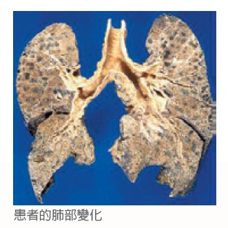 患者的肺部變化