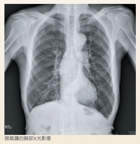 肺氣腫的胸部X光影像