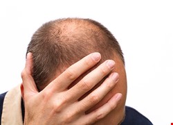 成功男性頭頂永遠的痛 談雄性禿的成因與治療