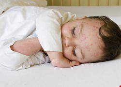 兒童蕁麻疹 醫師：症狀治療比找病因重要