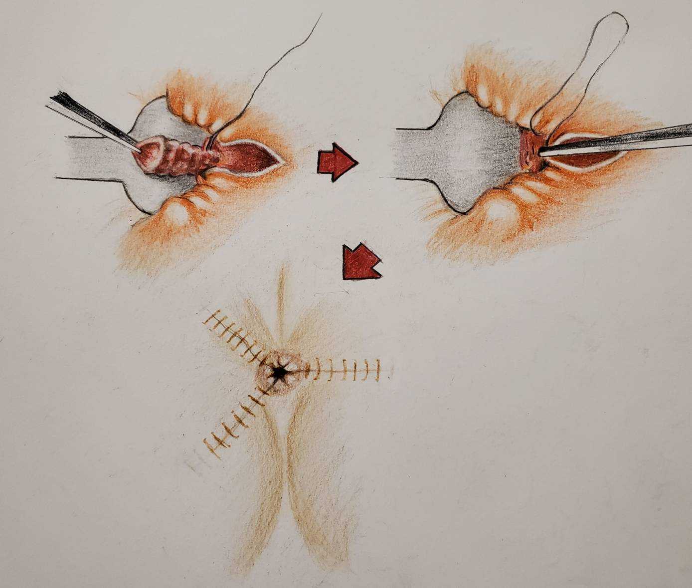 《新型雙極雷射痔瘡手術》談談原理及臨床成果
