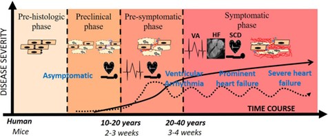 Pathogenesis of Arrhythmogenic Cardiomyopathy: Role of Inflammation img