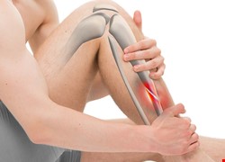 關節鏡輔助下脛骨平台骨折的微創治療(骨創傷科)